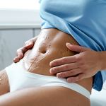 Topical Treatment Application**

"A woman with fair skin, wearing a modest, light blue cotton t-shirt, gently applying a small amount of silicone scar cream to a small, healed laparoscopy scar on her abdomen. The background is a bright, clean bathroom with soft lighting. Focus on the application technique and the texture of the skin. Safe for work, fully clothed, appropriate content, professional, perfect anatomy, correct proportions, natural pose, well-formed hands, proper finger count, natural body proportions."

**